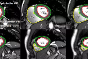 Displasia Arritmogênica do Ventrículo Direito: Como Reconhecer?