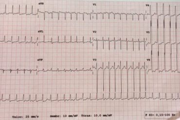 Desafio de ECG – Natal