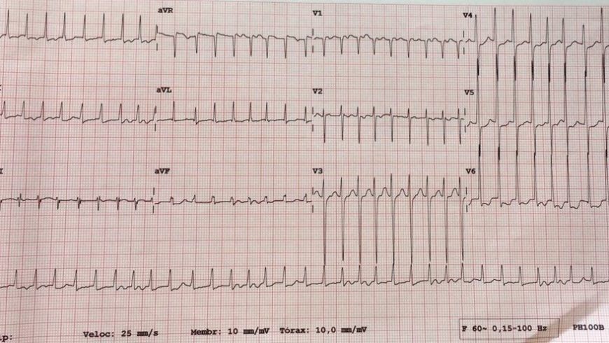 Desafio de ECG – Natal