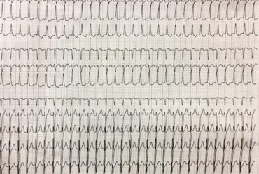 Desafio de ECG – Vitória